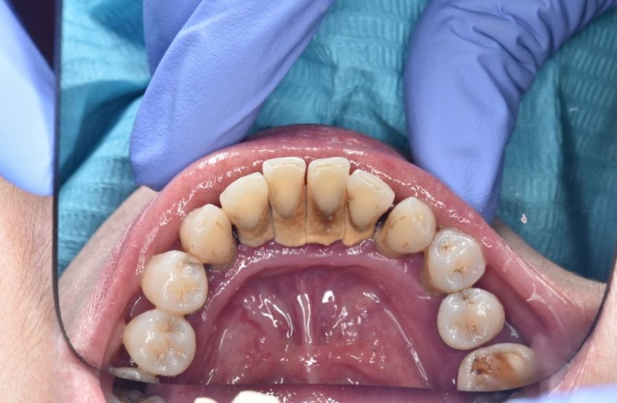 Manfaat Scalling Gigi