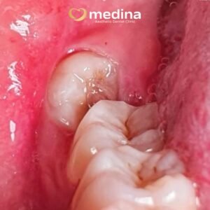 GIGI BUNGSU, Klinik Gigi Jepara Medina