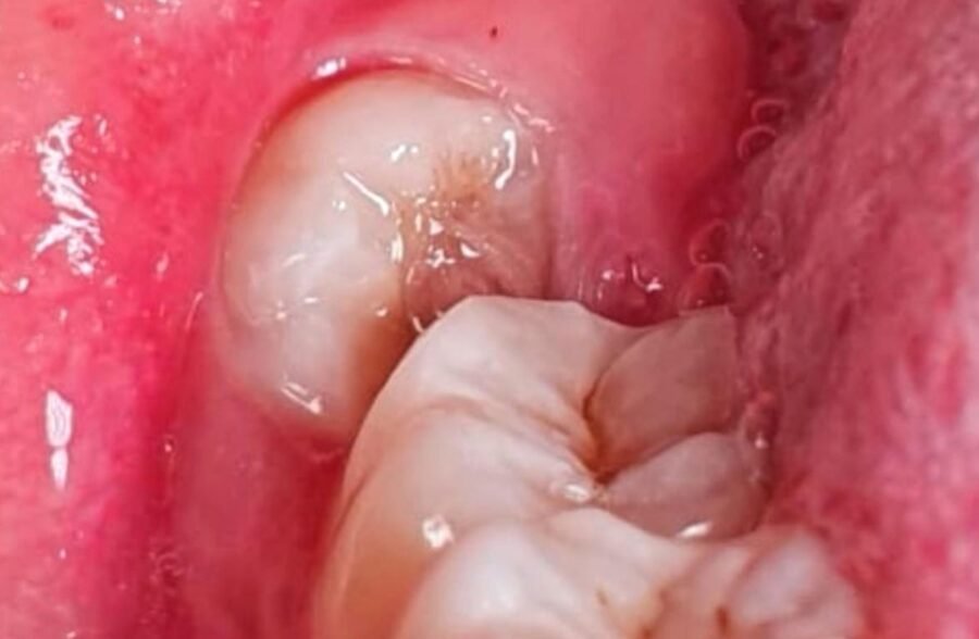 GIGI BUNGSU, Klinik Gigi Jepara Medina