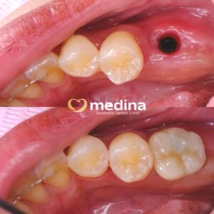 IMPLANT KLINIK GIGI MEDINA JEPARA