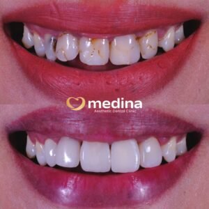 TAMBAL GIGI - KLINIK GIGI JEPARA