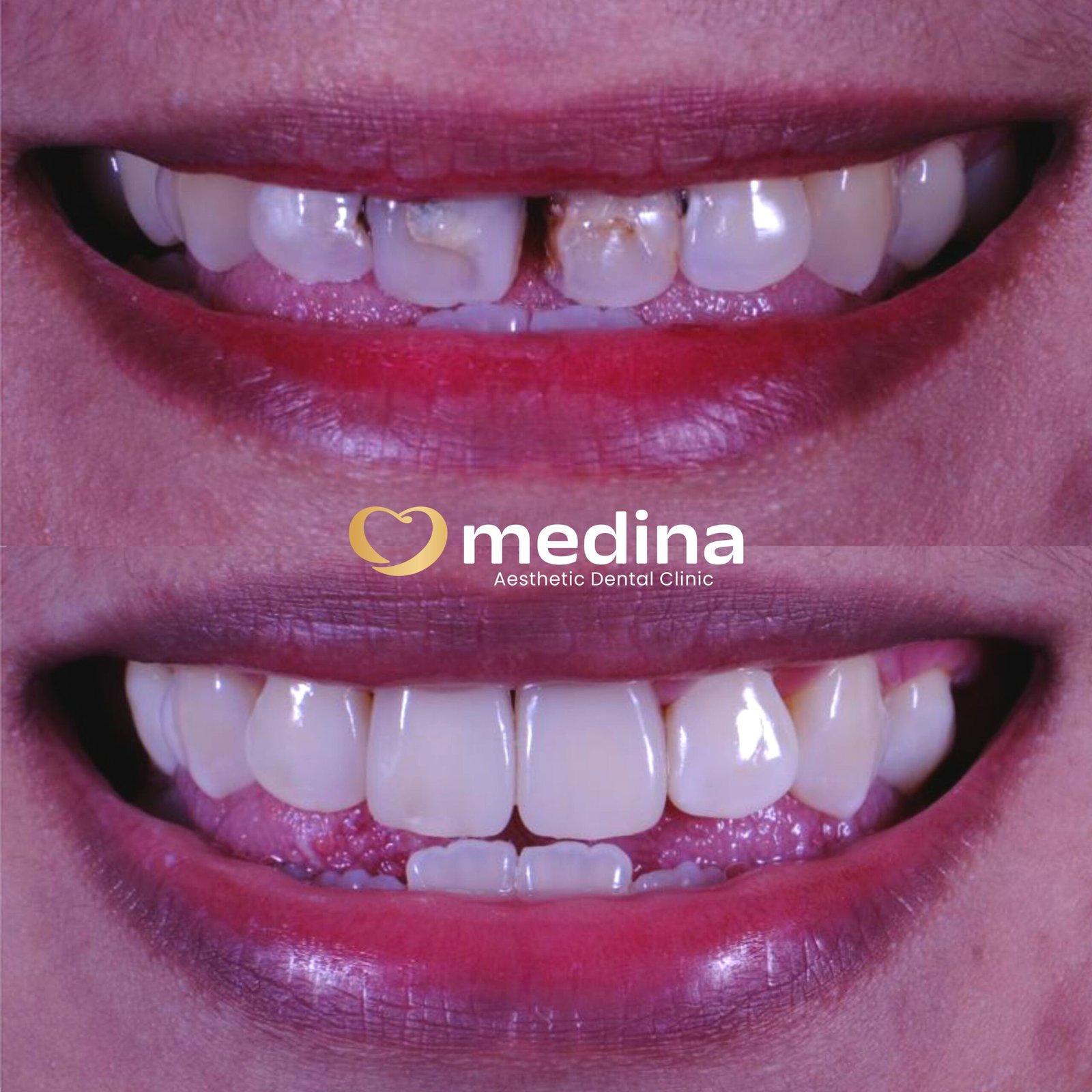 TAMBAL GIGI - KLINIK GIGI JEPARA