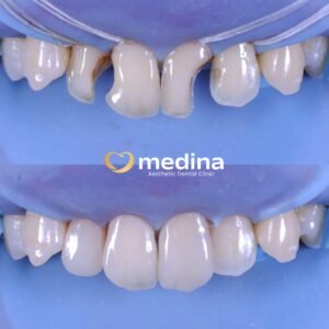 TAMBAL GIGI KLINIK GIGI MEDINA JEPARA