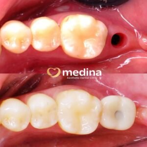 IMPLANT KLINIK GIGI JEPARA MEDINA