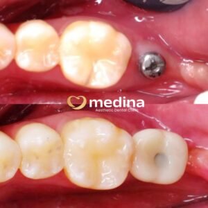 IMPLANT KLINIK GIGI MEDINA JEPARA