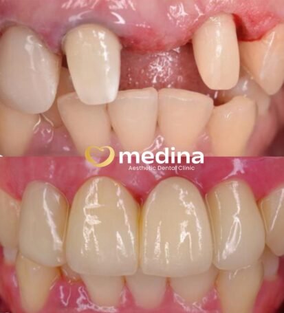 GIGI TIRUAN BRIDGE KLINIK GIGI JEPARA MEDINA