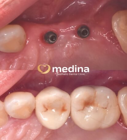 IMPLANT KLINIK GIGI JEPARA MEDINA