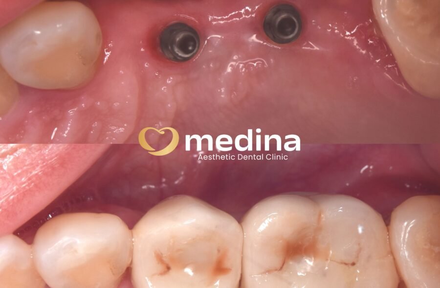 IMPLANT KLINIK GIGI JEPARA MEDINA