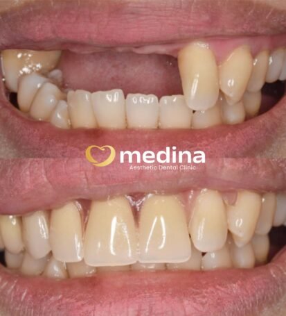 GIGI TIRUAN LEPASAN KLINIK GIGI JEPARA MEDINA