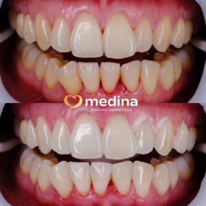 BLEACING GIGI KLINIK GIGI JEPARA MEDINA