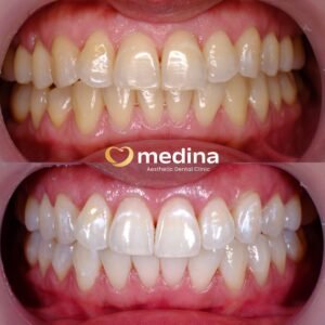 BLEACHING GIGI KLINIK GIGI JEPARA MEDINA