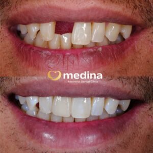 IMPLANT KLINIK GIGI JEPARA MEDINA