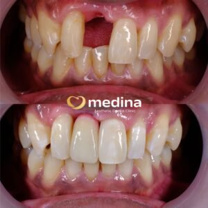 IMPLANT KLINIK GIGI JEPARA MEDINA