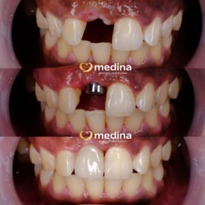 IMPLANT KLINIK GIGI JEPARA MEDINA