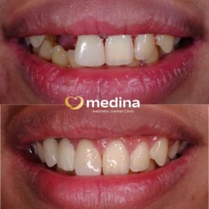 IMPLANT GIGI KLINIK GIGI JEPARA MEDINA