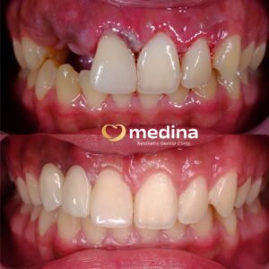 IMPLANT GIGI KLINIK GIGI JEPARA MEDINA