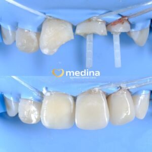 PERAWATAN SALURAN AKAR GIGI KLINIK GIGI JEPARA MEDINA