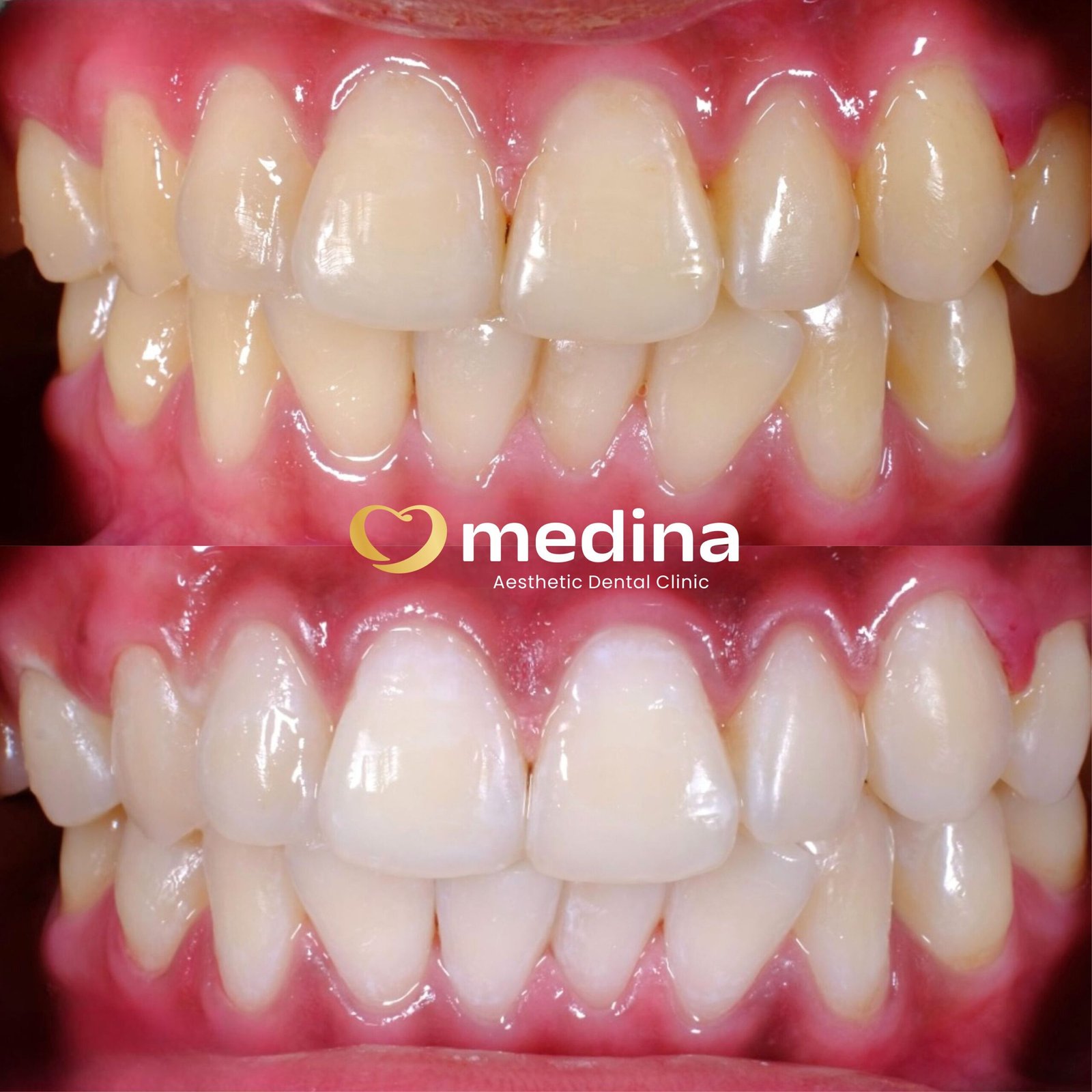 BLEACHING GIGI KLINIK GIGI JEPARA MEDINA