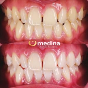 BLEACHING KLINIK GIGI JEPARA MEDINA