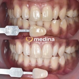 BLEACHING KLINIK GIGI JEPARA MEDINA