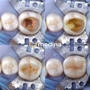 DOKTER GIGI JEPARA PERAWATAN SALURAN AKAR