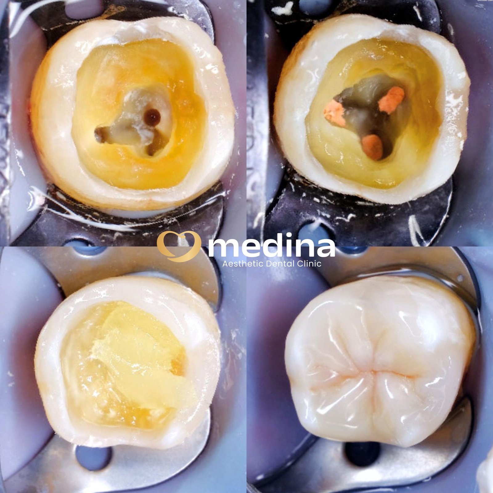 DOKTER GIGI JEPARA PERAWATAN SALURAN AKAR