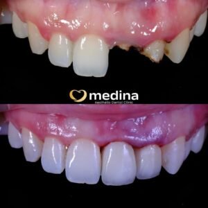 CROWN DOKTER GIGI JEPARA MEDINA