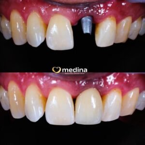 IMPLANT GIGI DOKTER GIGI JEPARA