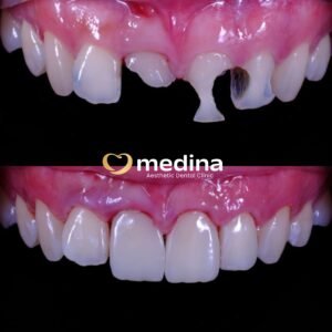 DOKTER GIGI JEPARA MEDINA CROWN GIGI