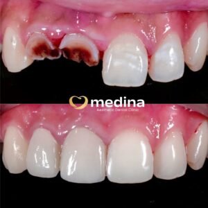 DOKTER GIGI JEPARA MEDINA CROWN GIGI