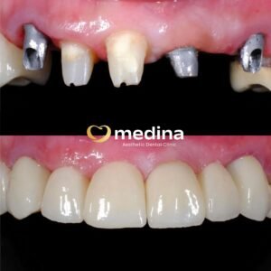 IMPLANT GIGI DOKTER GIGI JEPARA