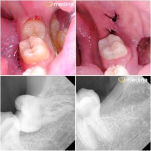 CABUT GIGI BUNGSU DOKTER GIGI JEPARA MEDINA