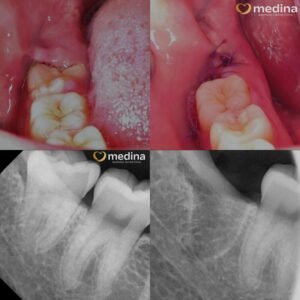 CABUT GIGI BUNGSU DOKTER GIGI JEPARA MEDINA