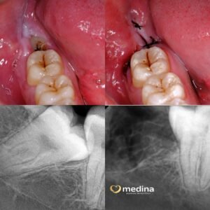 CABUT GIGI BUNGSU DOKTER GIGI JEPARA