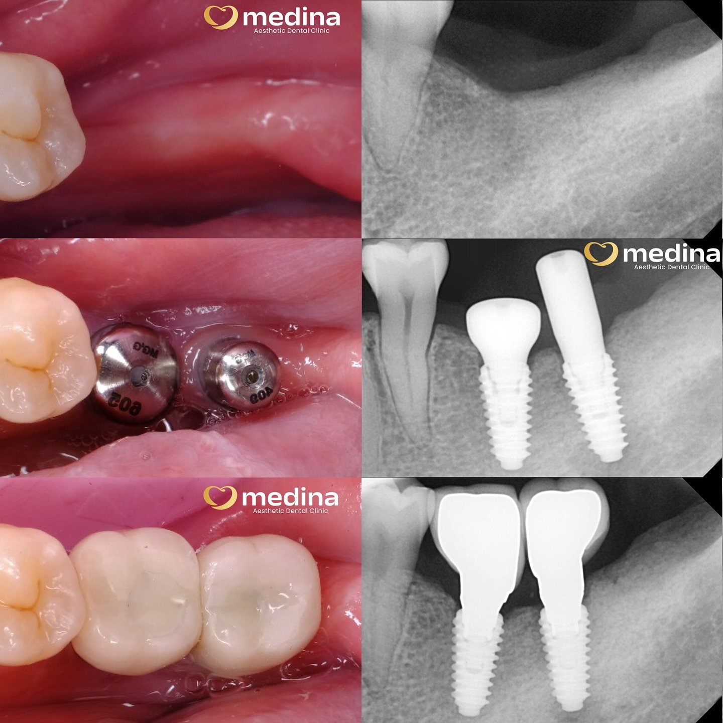 IMPLANT GIGI KLINIK GIGI JEPARA MEDINA