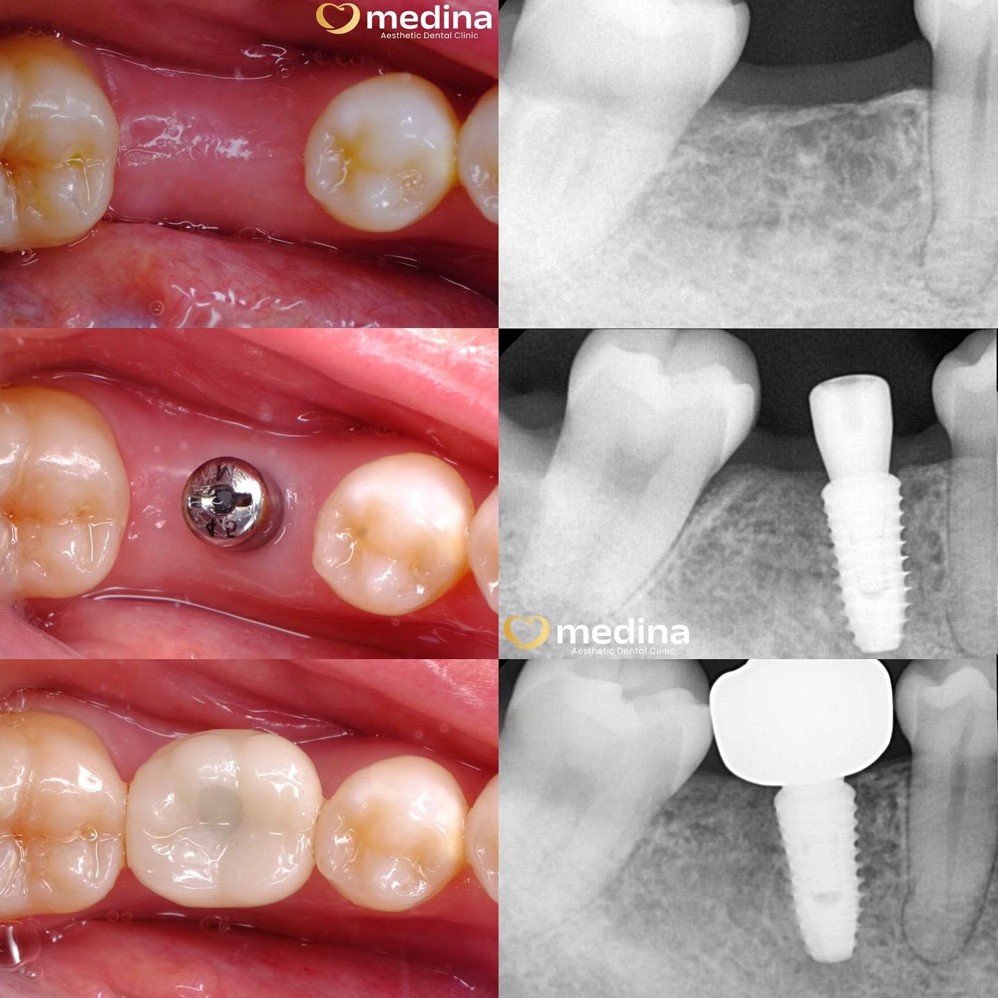 IMPLANT GIGI KLINIK GIGI JEPARA MEDINA