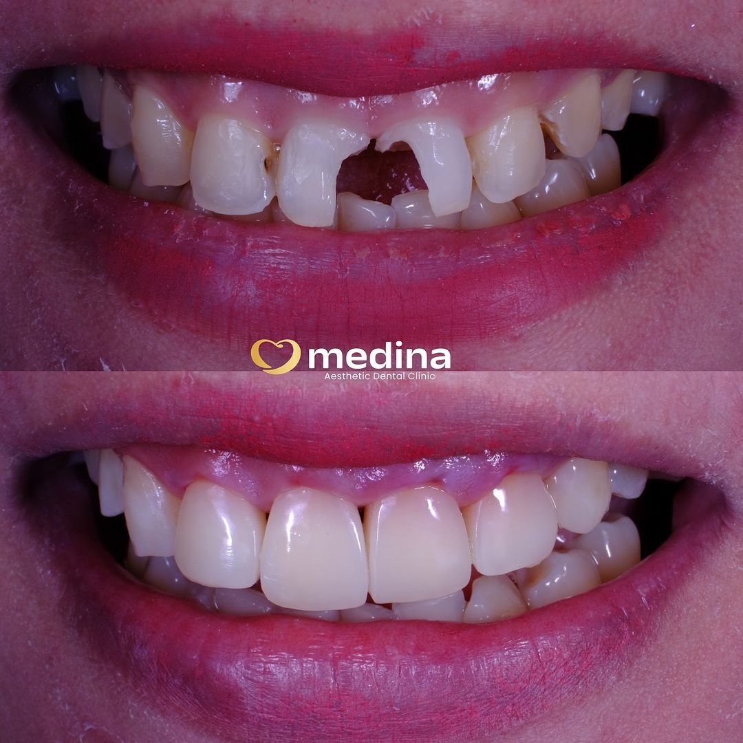 TAMBAL GIGI KLINIK GIGI JEPARA MEDINA