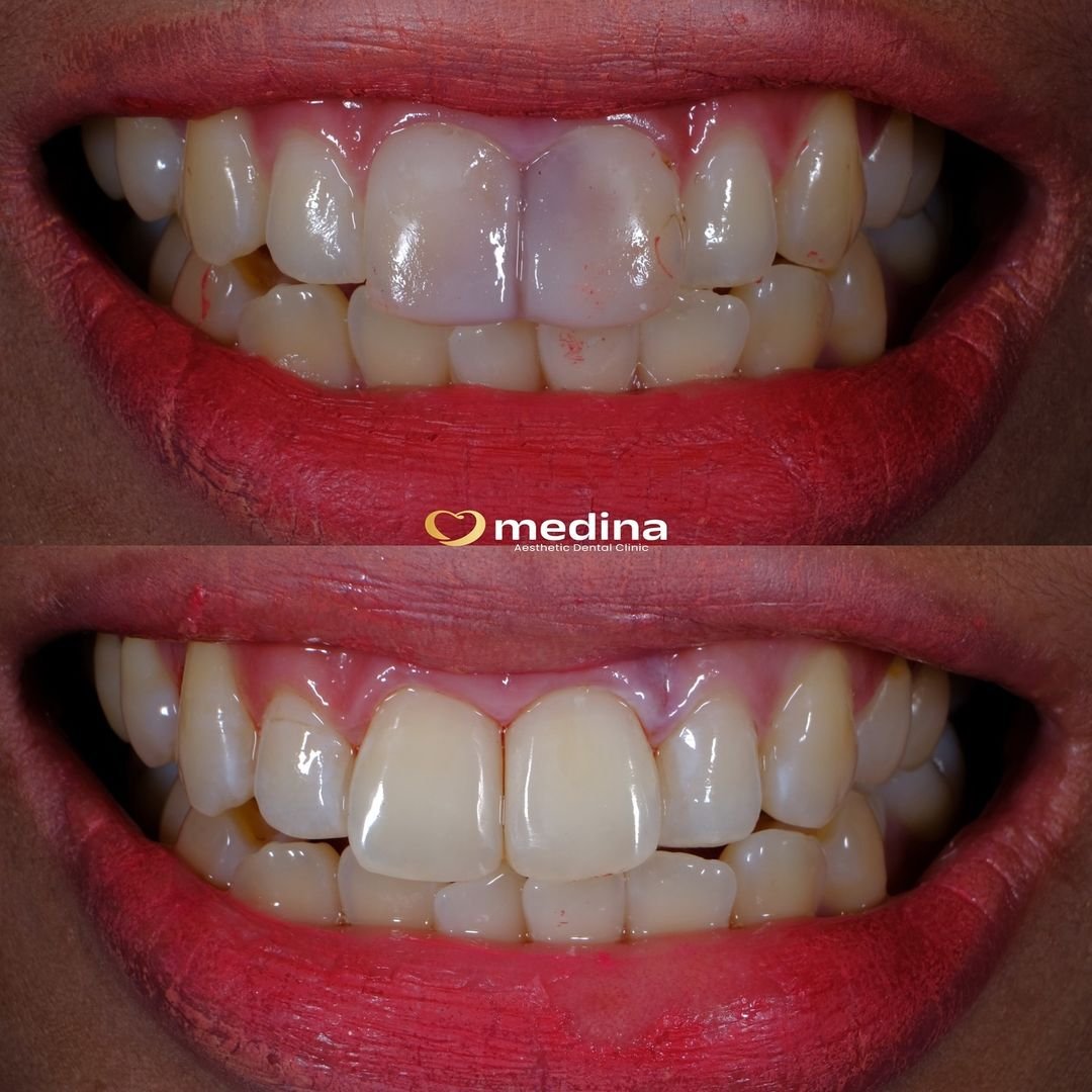 TAMBAL GIGI KLINIK GIGI JEPARA MEDINA